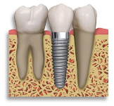 Dental Implants in Ahmedabad