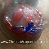 Cupping Therapy Chennai